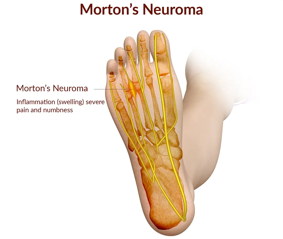 Morton s Neuroma Dubai Orthopedic Clinic DRHC Morton s Neuroma Dubai Orthopedic Clinic DRHC