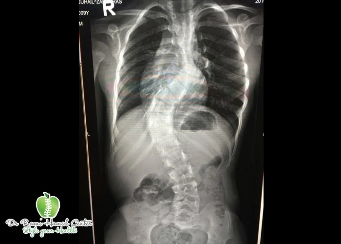 scoliosis dubai