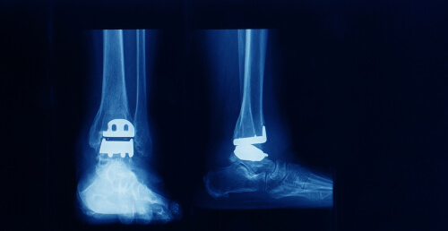 Osteoarthritis Foot and Ankle Dubai Orthopedic Clinic