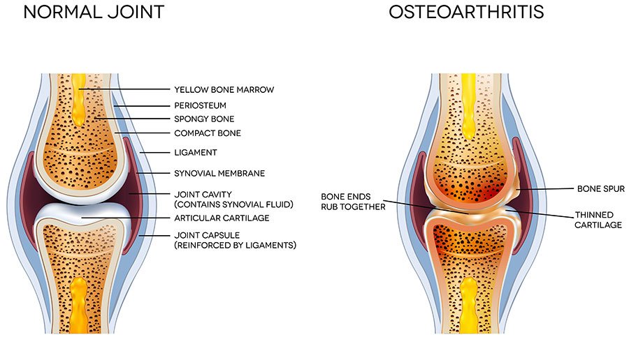 Osteoarthritis