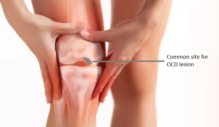 Osteochondritis Dissecans (OCD)