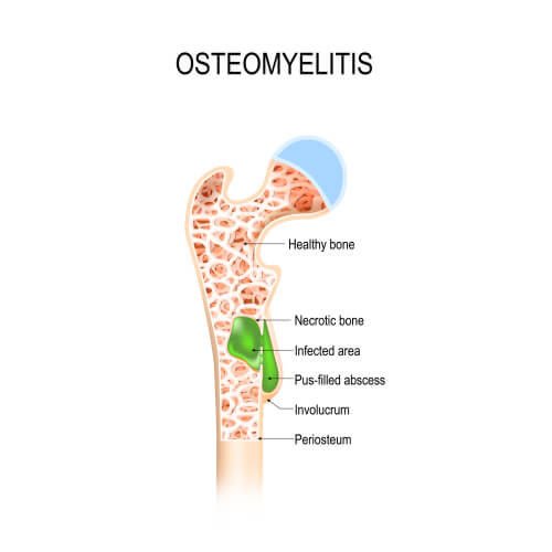 Osteomyelitis  DRHC Dubai Pediatric Orthopedic