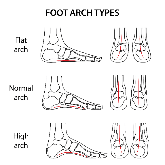 Pediatric Flatfoot - Pediatric Orthopedic Clinic Dubai