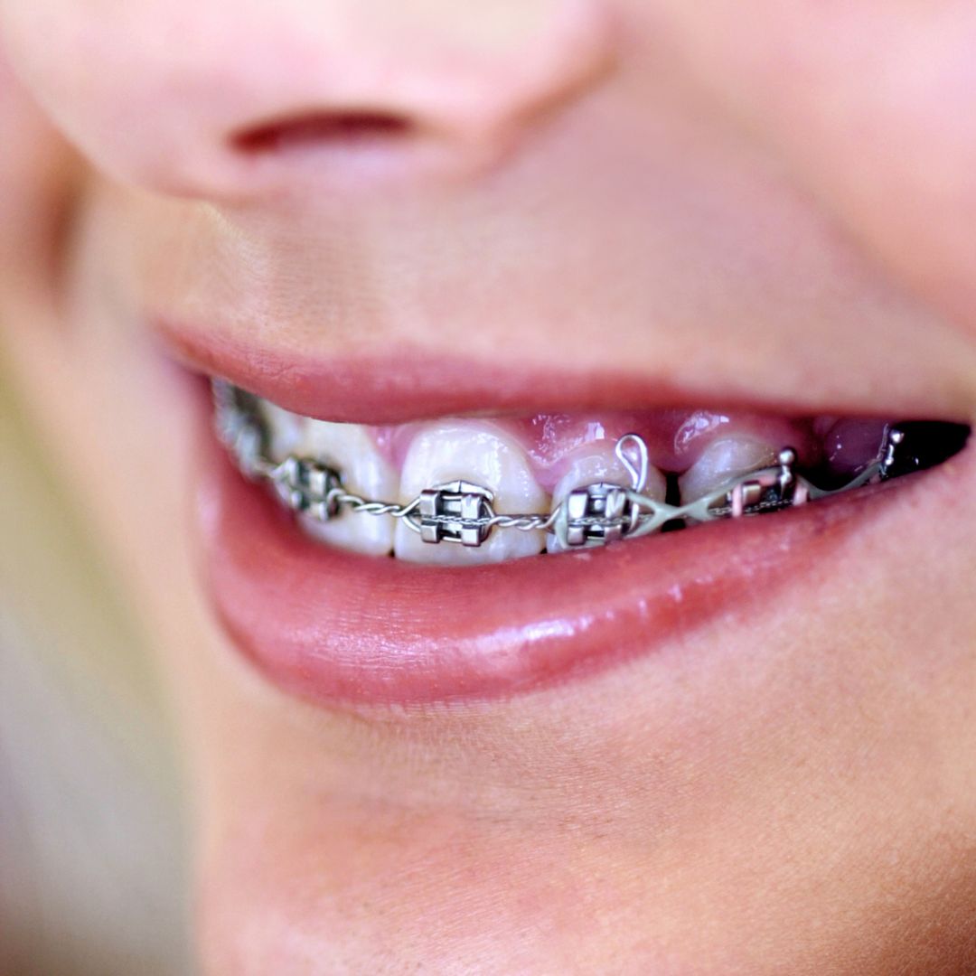 Pediatric Orthodontics