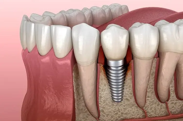 Peri-Implantitis Treatment