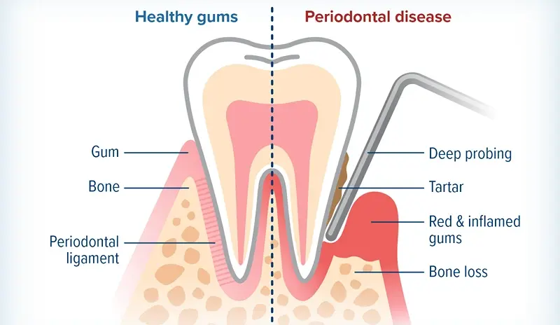 Periodontal Disease