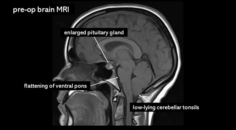 Pituitary MRI Dubai
