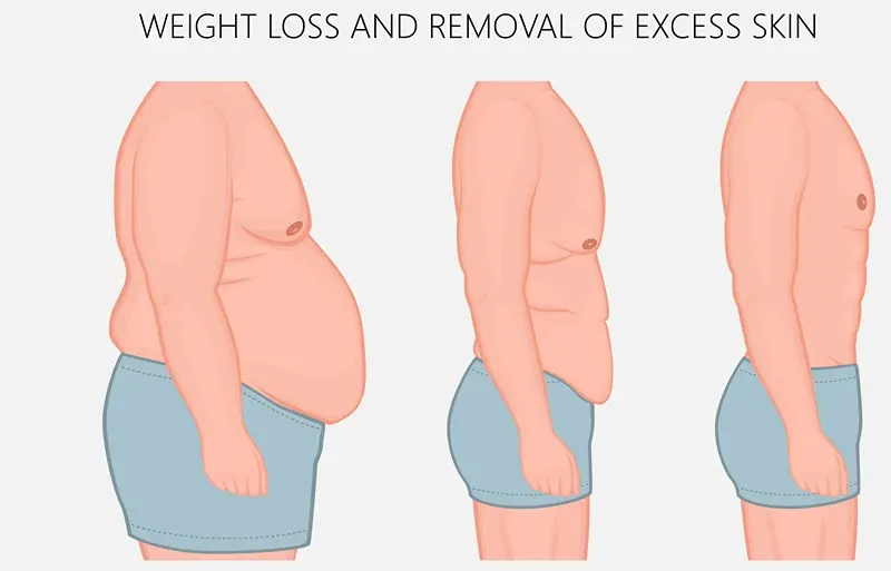 Post Weight Loss Surgery
