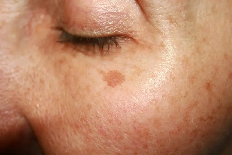 Precancerous Lesions (Actinic Keratosis) in Dubai