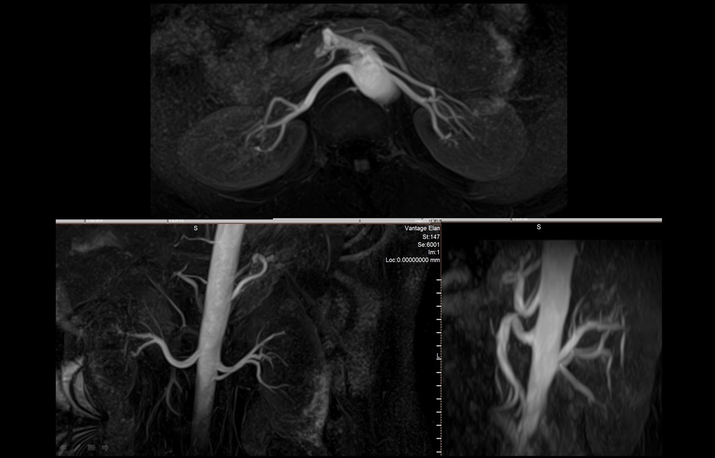 mra_renal_slide0.jpg