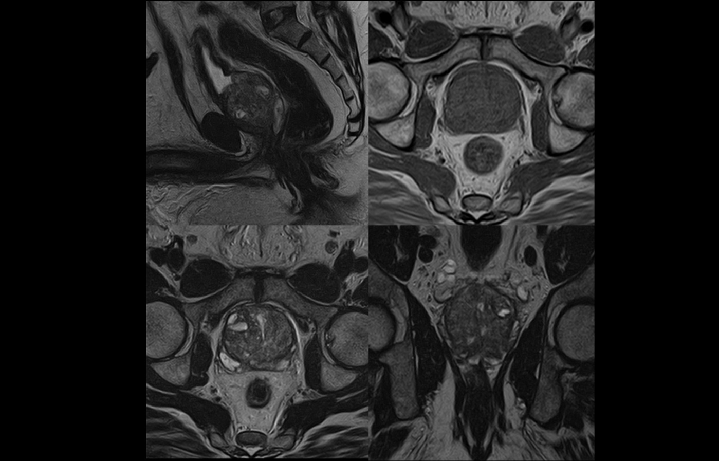 mri slide prostate