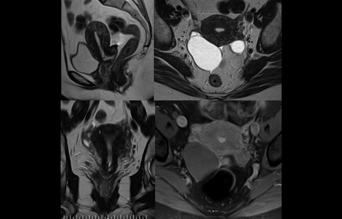 mri slide uterus