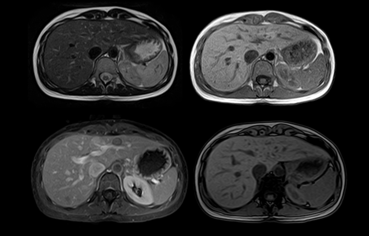 mri slide abd