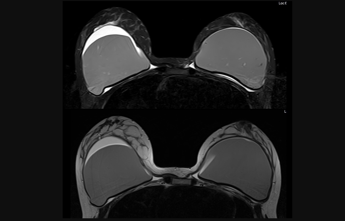 mri breast slide