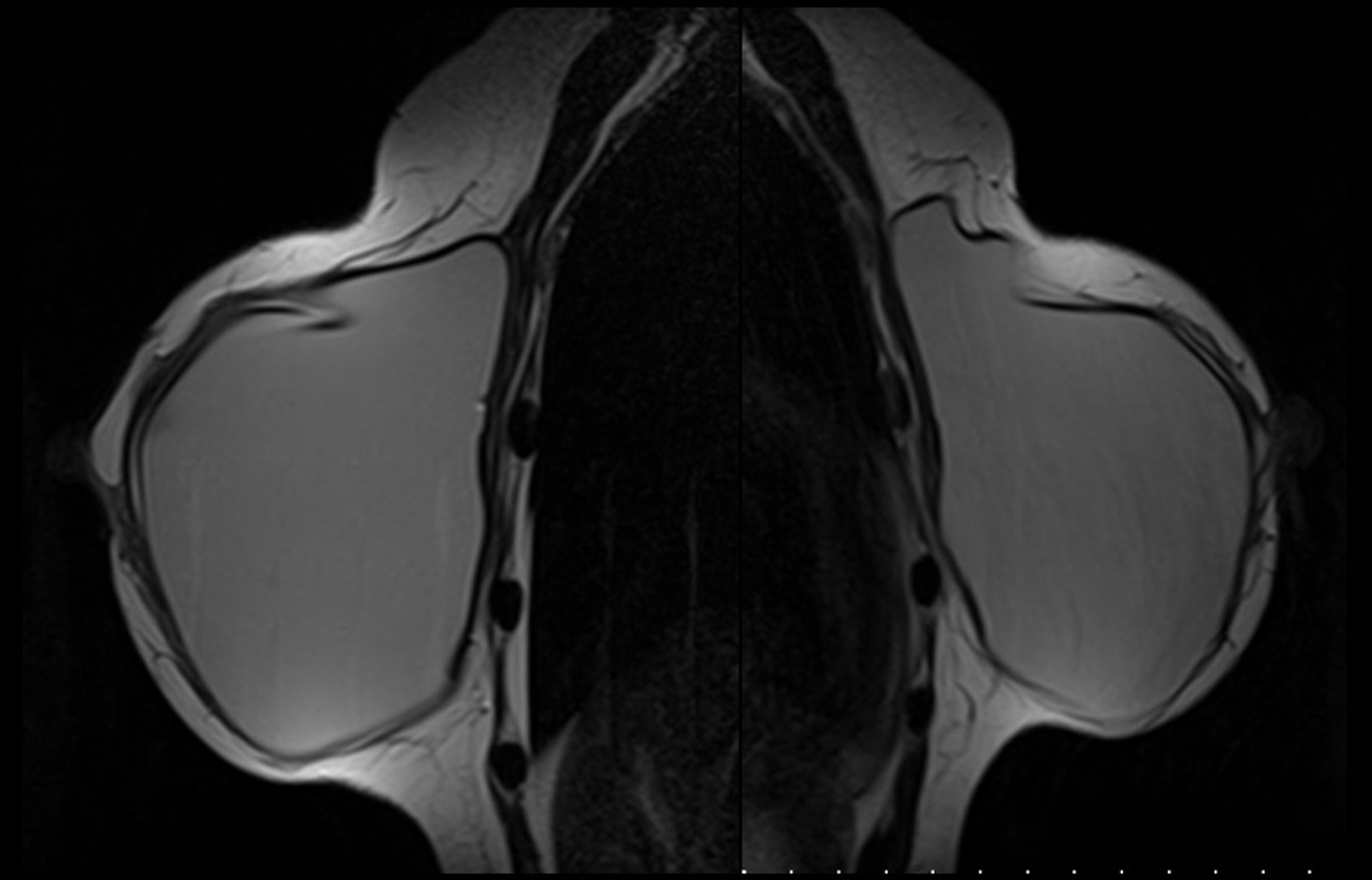 mri slide breast