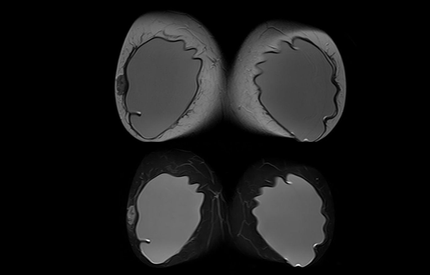 mri slide breast