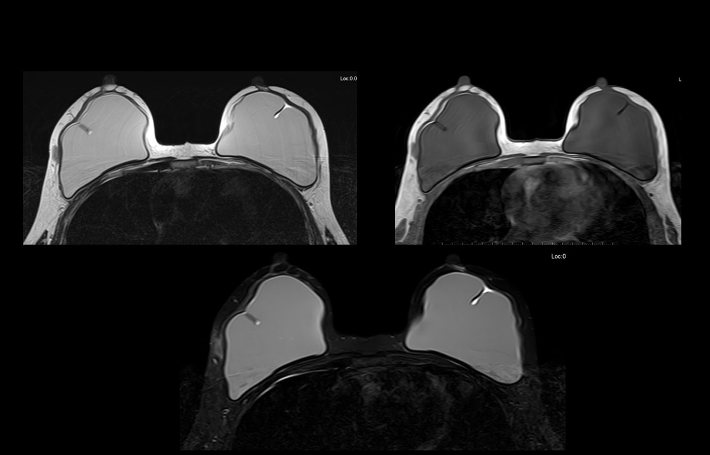 mri slide breast