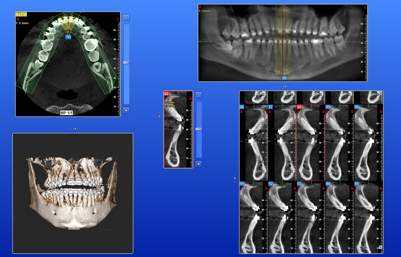 CBCT 3D