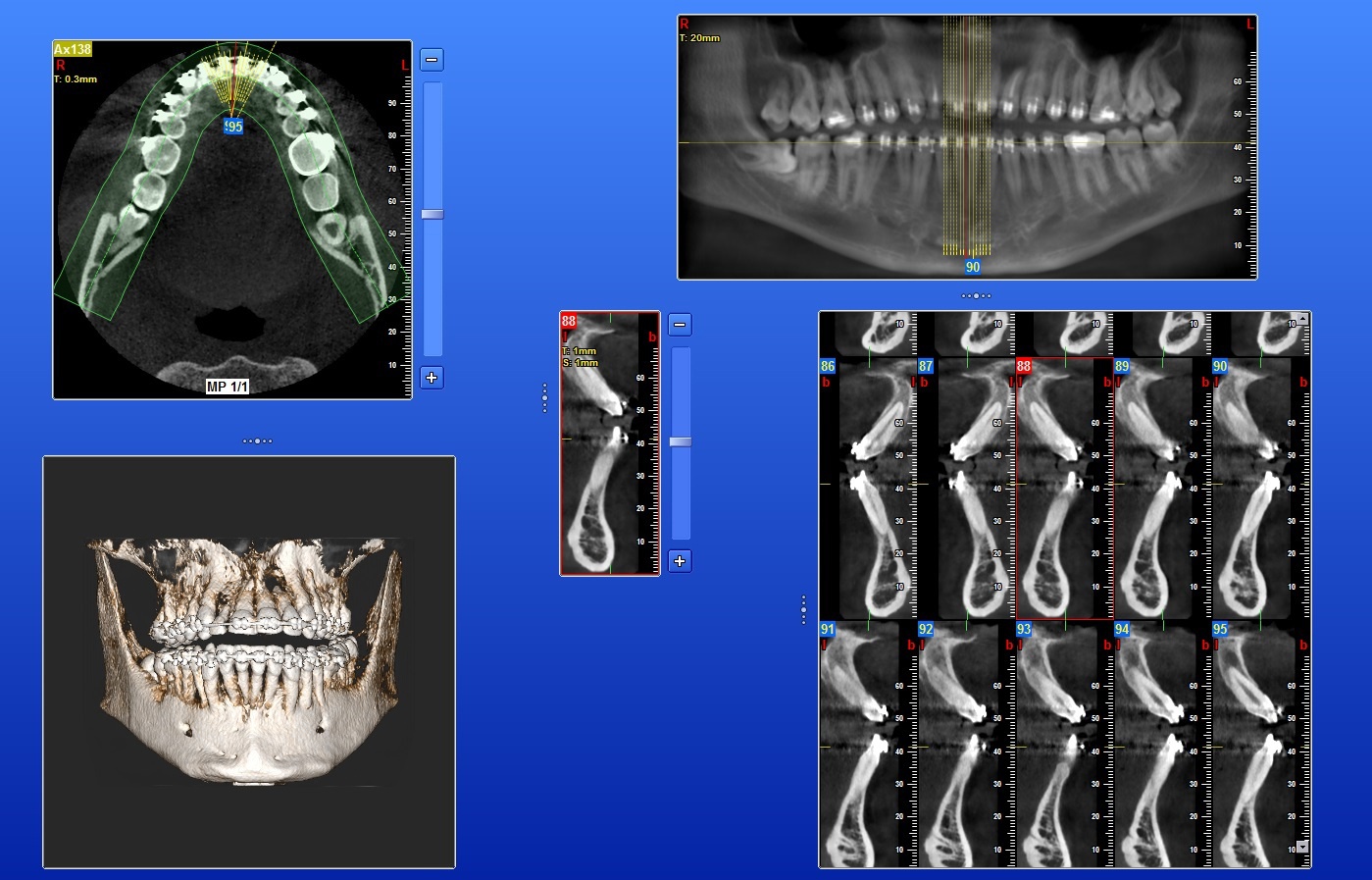 cbct