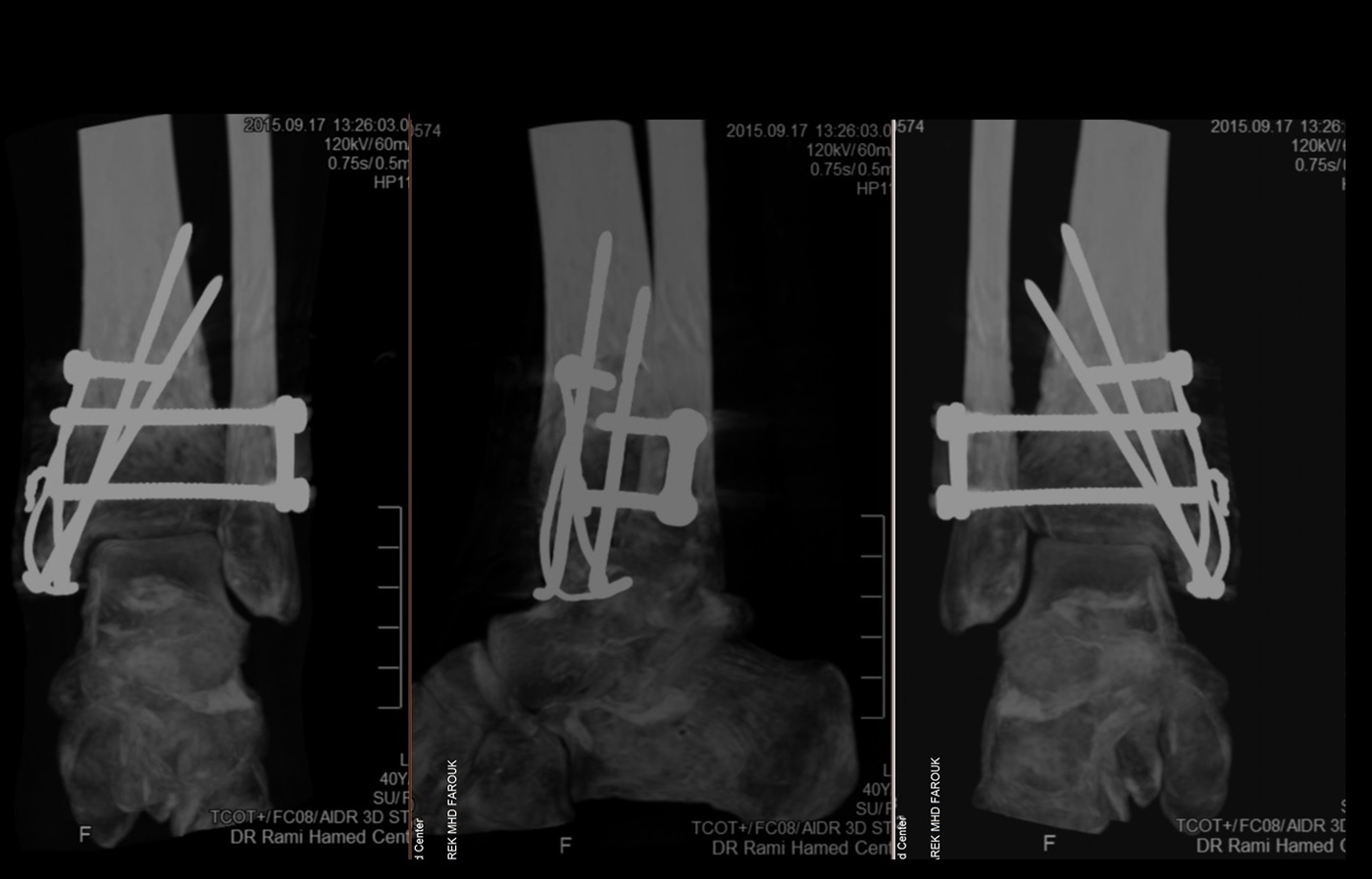 ct slide ankle