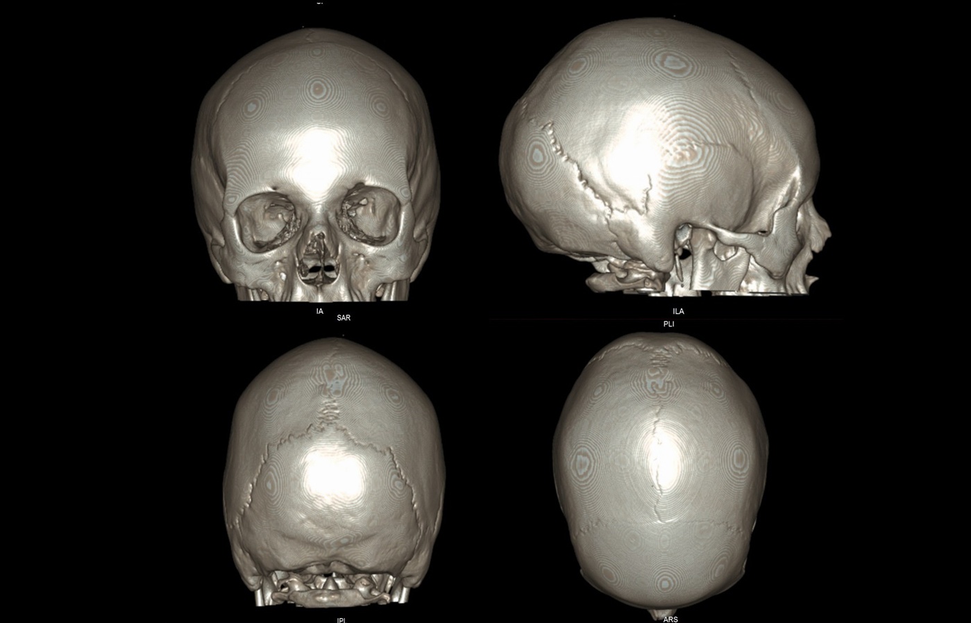 CT Skull 3D