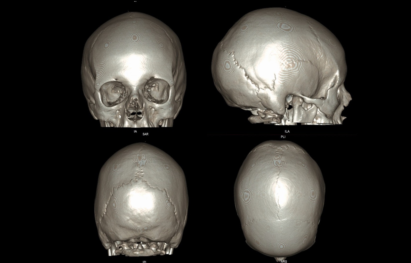 ct slide skull 3d