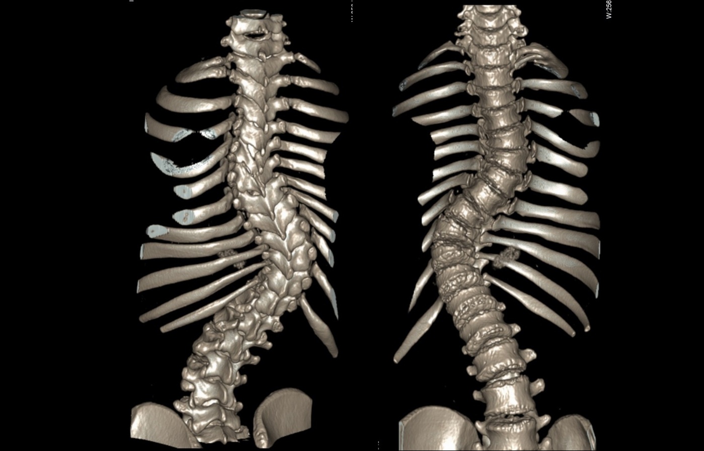 ct slide spine 3d