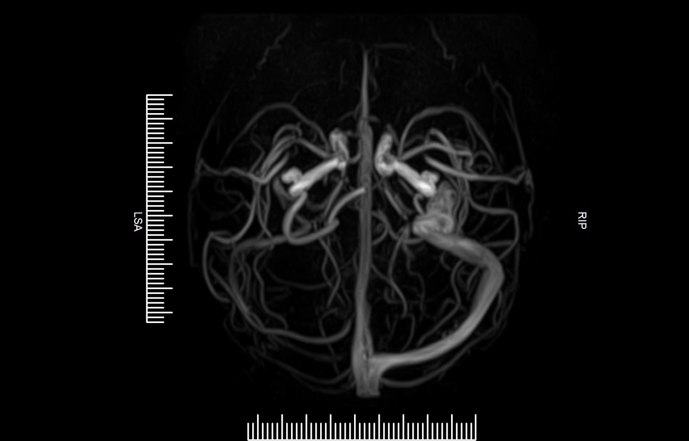 MRI Brain