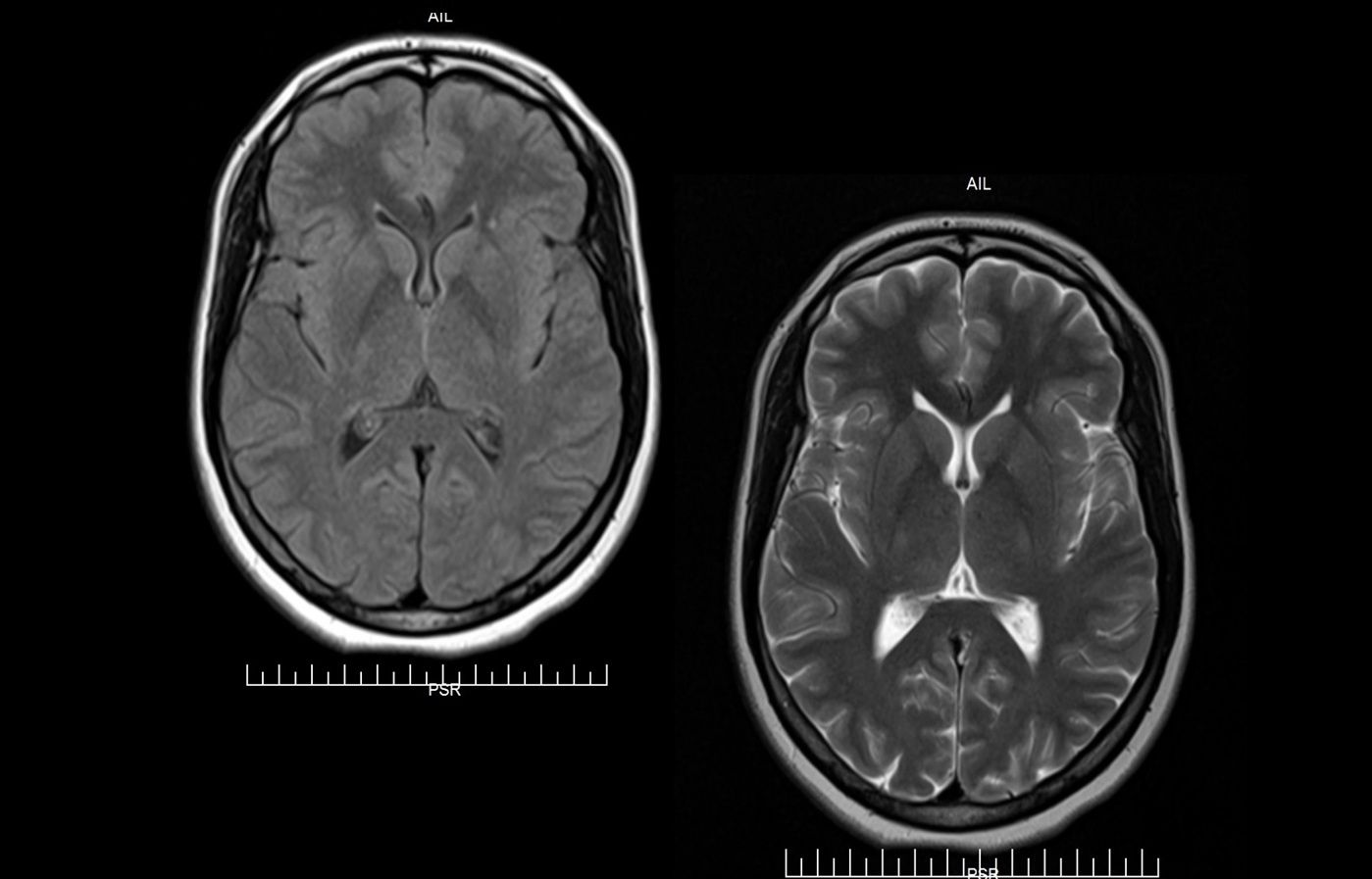 Neuro MRI