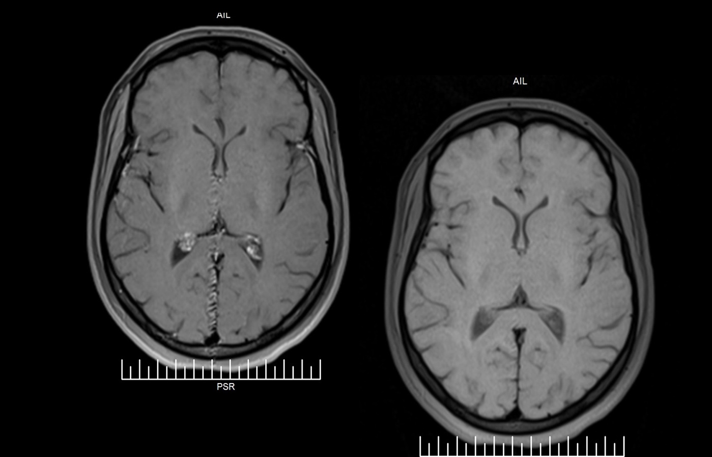 Neuro MRI