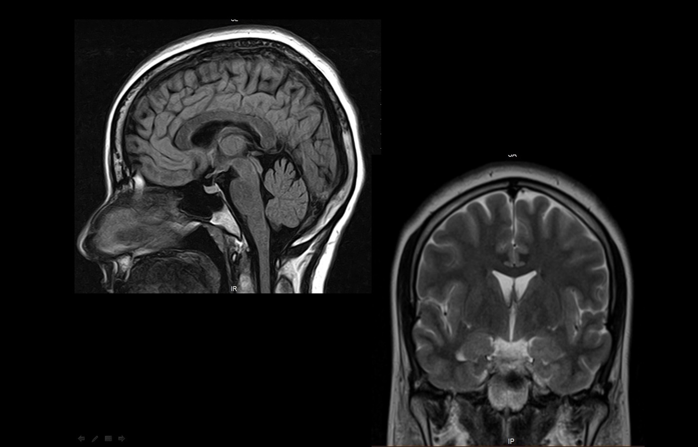 Neuro MRI