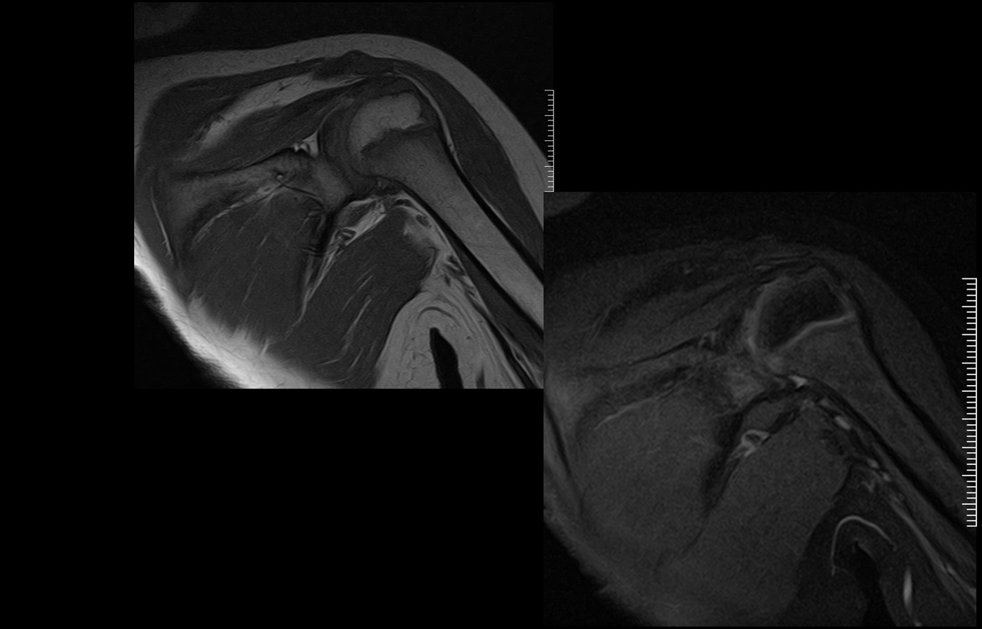 mri slide Shoulder