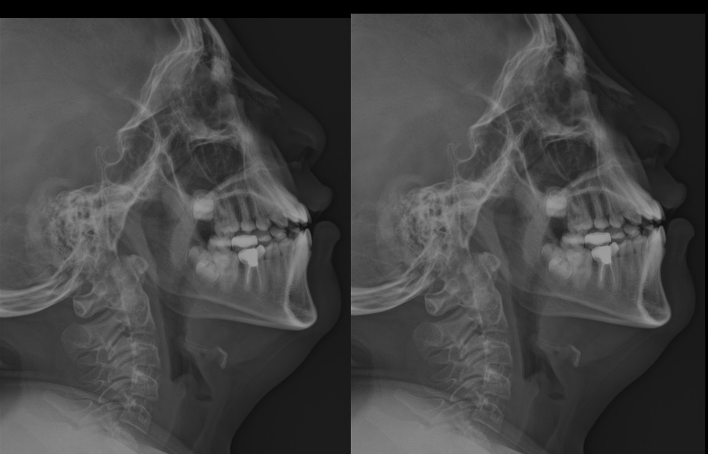 xr slide adenoid