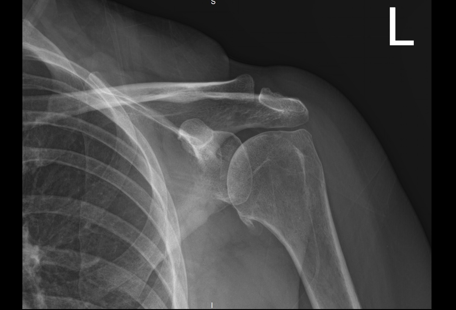 X-Ray