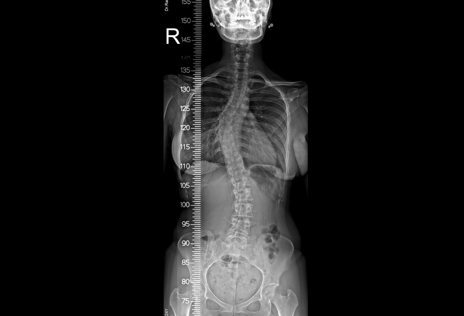 X-Ray