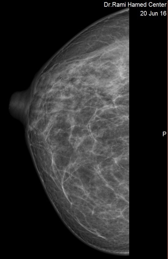 DIGITAL MAMMOGRAPHY