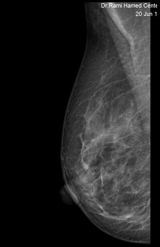 DIGITAL MAMMOGRAPHY