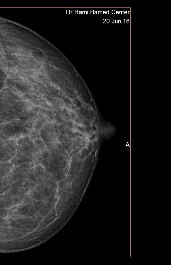 DIGITAL MAMMOGRAPHY