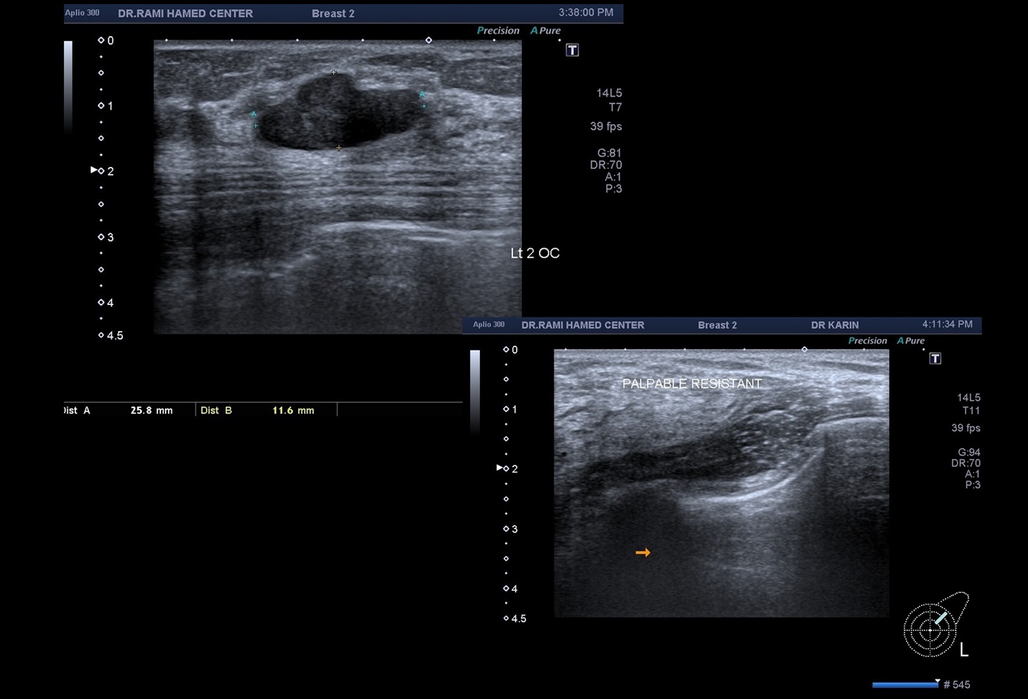 Ultrasound Breast