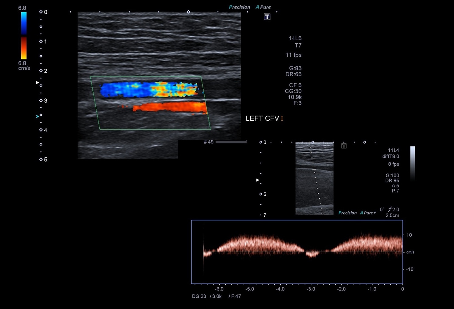 Doppler Ultrasound