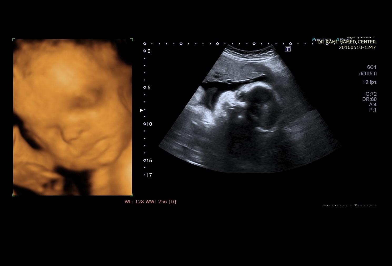 Ultrasound Fetal 3D & 2D
