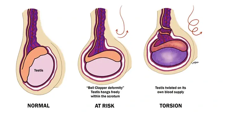 Scrotal & Testicular Conditions