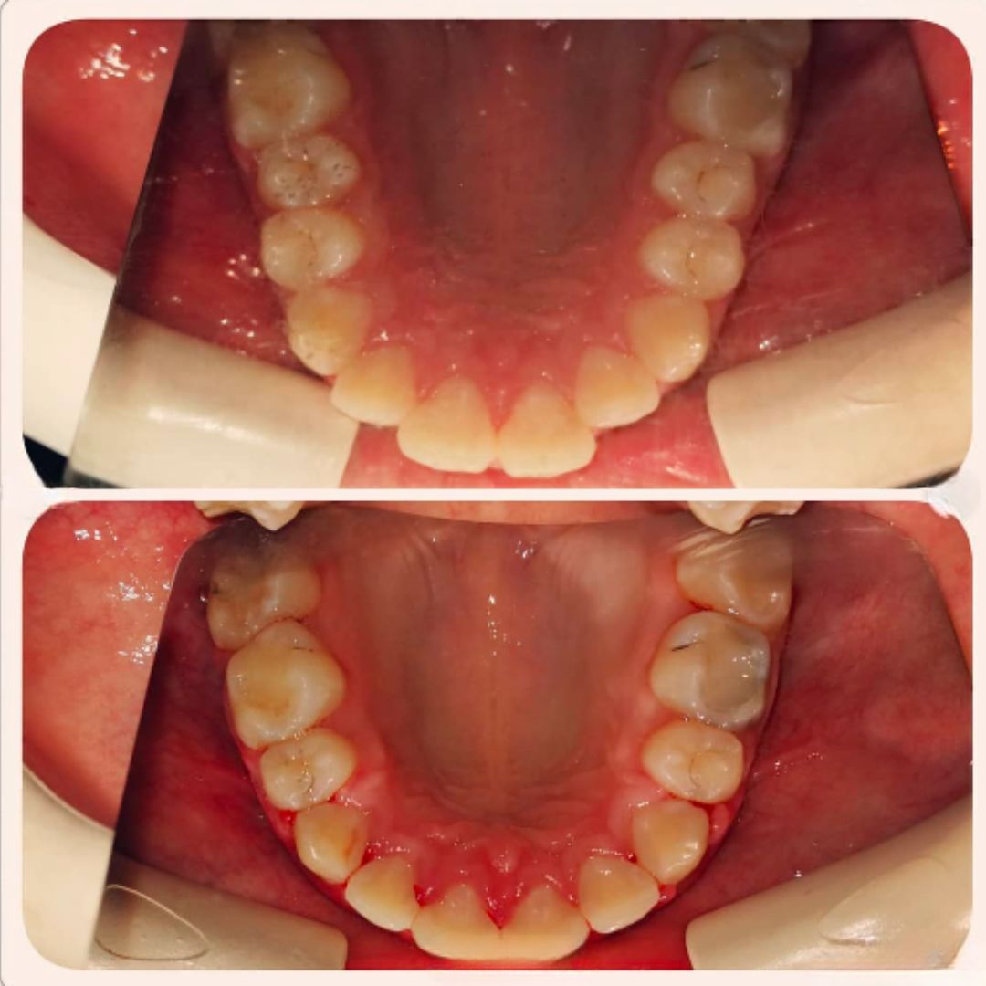 Self ligating braces