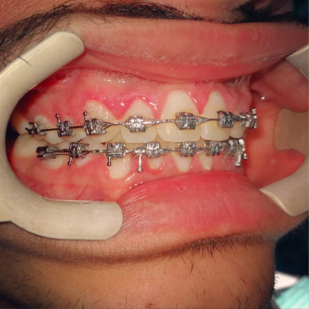Self ligating braces