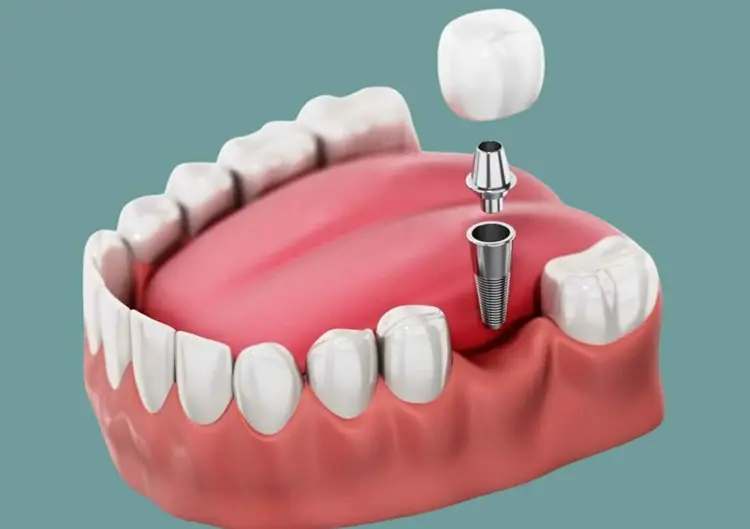 Single Tooth Implant