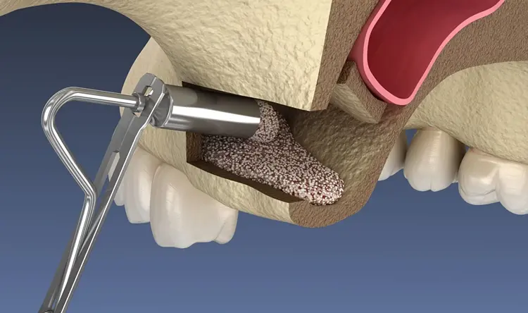 Sinus Lift Surgery