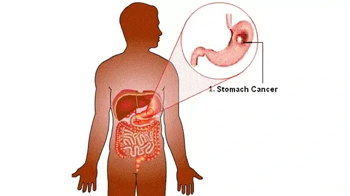 Stomach Surgery for benign and malignant diseases