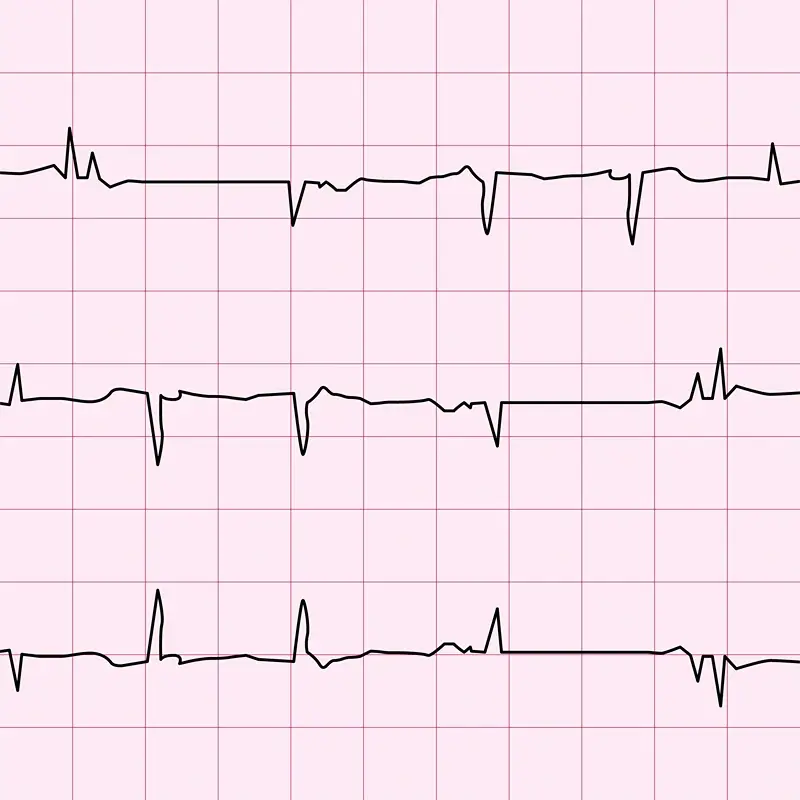 Stroke and Heart Disease