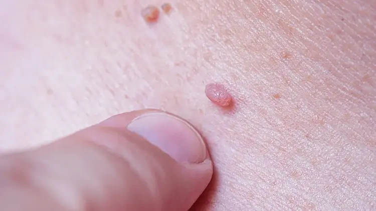 Surgical Excision of Large Genital Warts