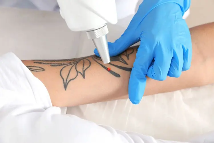 Tattoo Removal Dubai